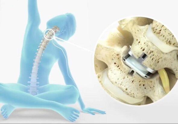 Spinal Disc Replacement