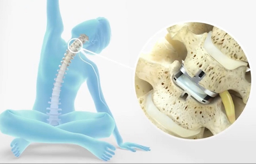 Spinal Disc Replacement