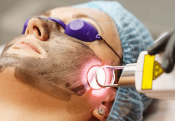 Laser Skin Treatments